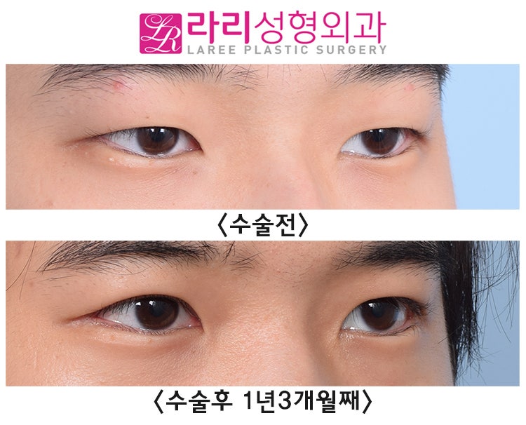 [Lari Plastic Surgery] Incisional Eyelid Correction + Lateral Canthoplasty for Men, and Before-and-After Photos of Hump Nose Osteotomy Surgery Using Ear Cartilage and Septal Cartilage image 2