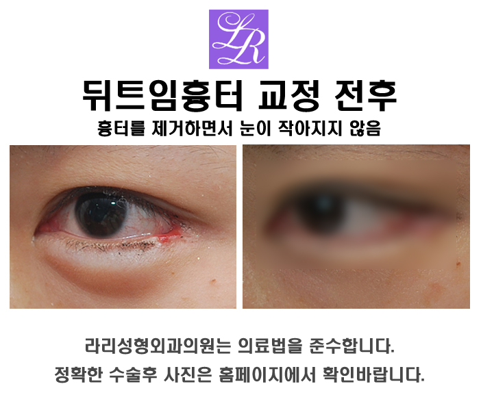 뒤트임 재수술 할때 눈꼬리 흉터 걱정쓰 관련 이미지 4