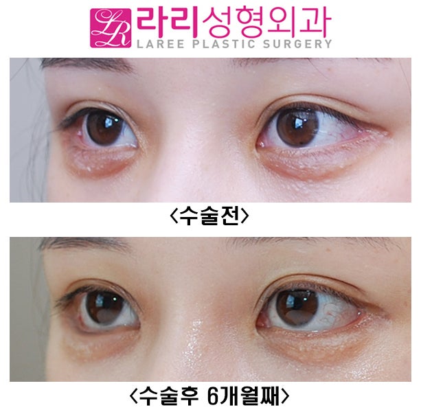 [Rari Plastic Surgery] If You Want a Successful Lower Canthoplasty, NO to Aegyo Filler image 3