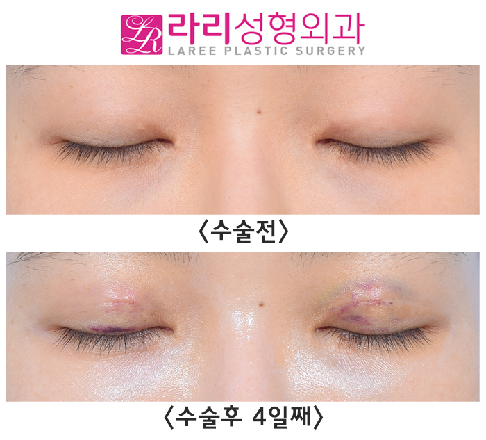 [라리성형외과] 비절개 재수술로 짝짝이 눈 교정하기 관련 이미지 4