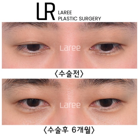 [라리성형외과] 쌍꺼풀없애는 무쌍 수술, 쌍꺼풀라인 낮추기가 아닙니다. (완전무쌍과 무쌍속쌍 그 차이) 관련 이미지 8
