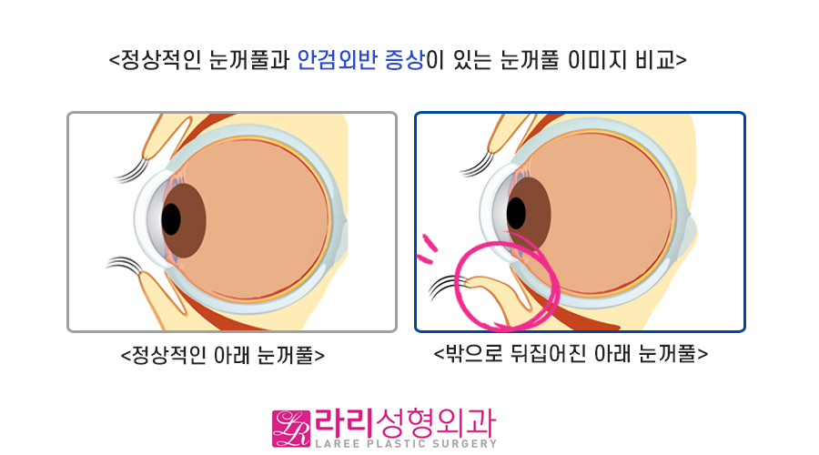 [Lari Plastic Surgery] What Is Ectropion? The Definition and Causes of Ectropion image 1
