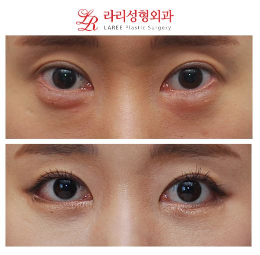 [Big-Eyed Canthoplasty] Revision Surgery for Lateral Canthoplasty to Lower the Outer Eye Corner / Revision Surgery for Lowering the Outer Eye Corner, Before-and-After Photos of Under-Eye Fat Repositioning image 3