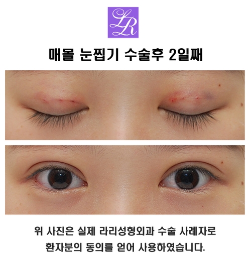 Double Eyelid Burden After Buried Sutures - What Is It Like on Day 2? image 4
