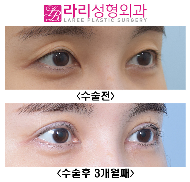 [라리성형외과] 풀린 쌍꺼풀재수술 아웃라인으로 크고 예쁘게 재탄생! 관련 이미지 2