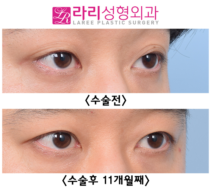 [Lari Plastic Surgery] Surgery Before-and-After Photos for Removing Multiple Eyelid Folds That Are Hard to Leave Alone image 4