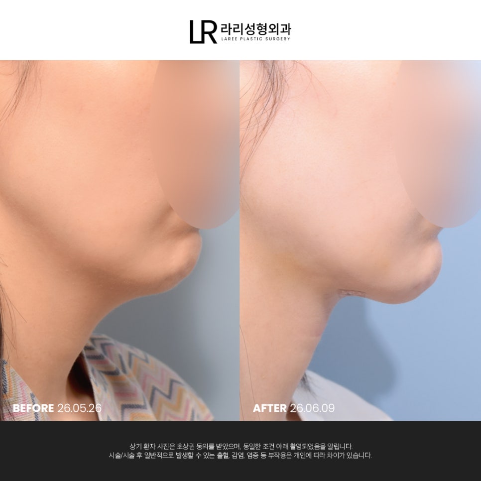 [라리성형외과] 이중턱 지방 흡입만으로는 아쉬운 얼굴 라인, 이중턱 근육 묶기도 같이 하면 효과가 두 배! 관련 이미지 5