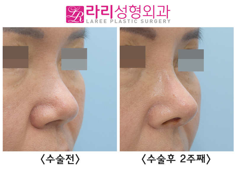 [라리성형외과] 코재수술, 입툭튀를 개선하는 고양이수술 효과 전후 사진 관련 이미지 1