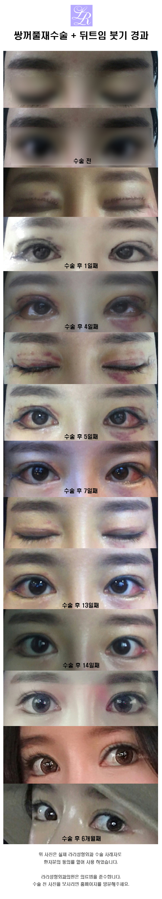 Is Swelling After Lateral Canthoplasty, Conjunctival Edema, a Side Effect? image 4