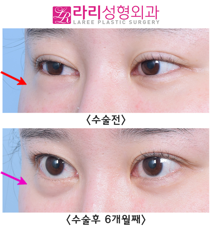 [라리성형외과] 눈밑이물질(스컬트라)제거 수술 전후 사진 차이 관련 이미지 5