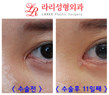 앞트임흉터제거 및 앞트임복원/앞트임재건의 효과를 알아보자! 관련 이미지 1