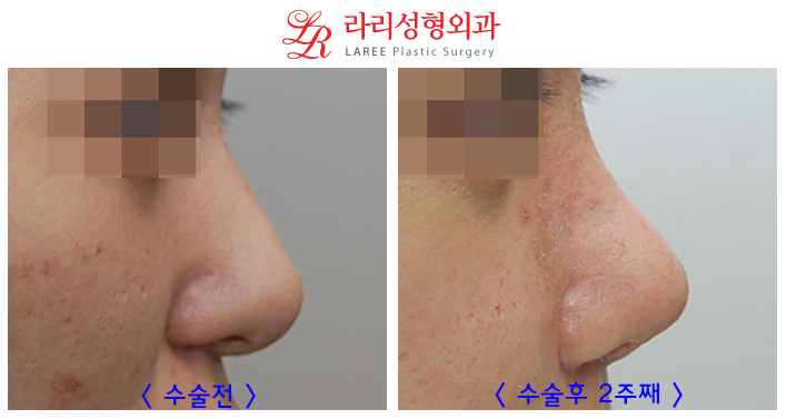 코재수술 잘하는곳 변화가 확실한 라리성형외과! 관련 이미지 6