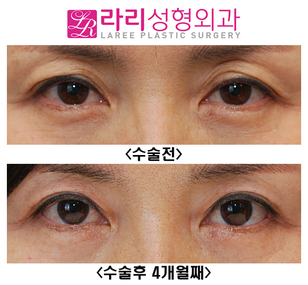 [라리성형외과] 앞쪽이 두껍고 불규칙한 쌍꺼풀라인 정리 수술 전후 관련 이미지 1