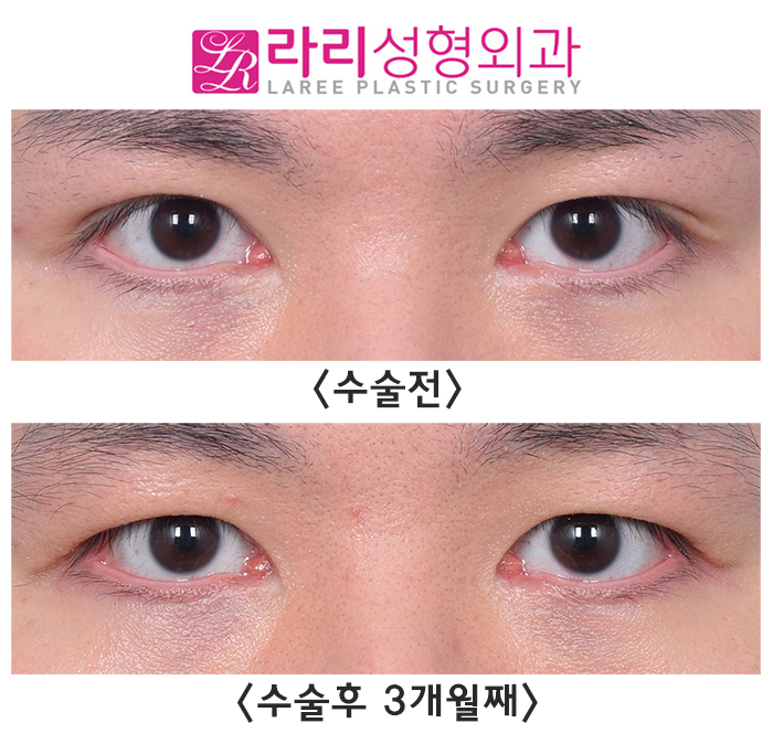 [라리성형외과] 쌍수 흉터까지 없애는 쌍꺼풀없애기수술 전후 사진 보기 관련 이미지 1