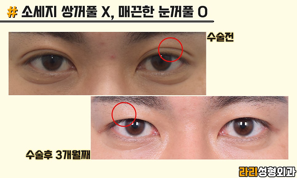 [Lari Plastic Surgery] Men’s Eye Surgery, Trends and Desired Look - Monolid & Hidden Double Eyelid image 4