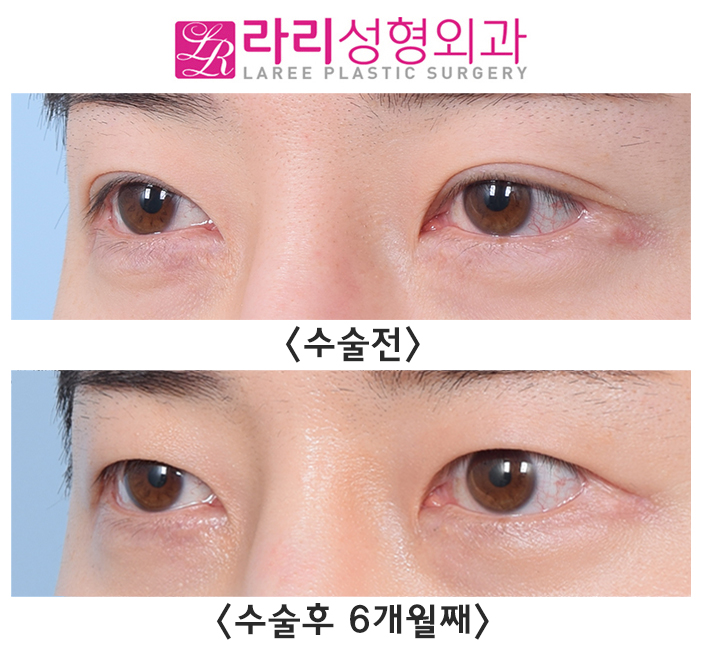[라리성형외과] 매몰 쌍수 흉터 없애는데 쌍꺼풀없애는수술이 좋을지도?! 관련 이미지 4