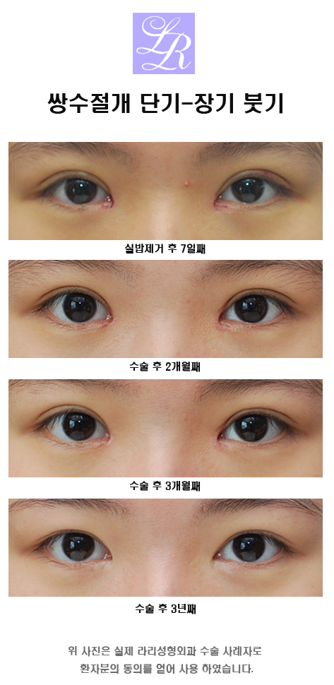 Swelling After Suture Removal Following Double Eyelid Surgery: Curious image 5