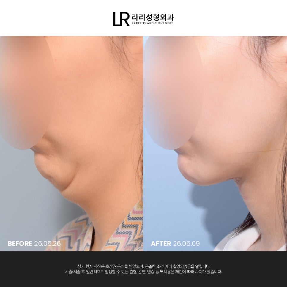 [라리성형외과] 이중턱 지방 흡입만으로는 아쉬운 얼굴 라인, 이중턱 근육 묶기도 같이 하면 효과가 두 배! 관련 이미지 2