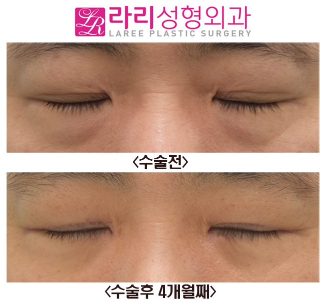 [Rari Plastic Surgery] Before-and-After Photos of Surgery to Remove the Double Eyelid Fold and Epicanthoplasty image 2