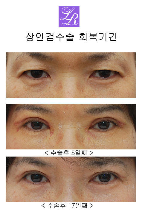 상안검수술, 하안검수술- 수술전후, 경과 궁금쓰 관련 이미지 6