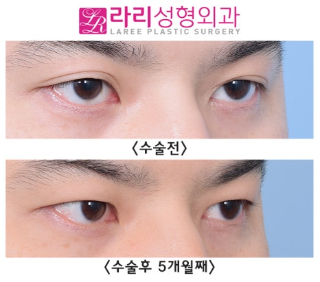 [Lari Plastic Surgery] Completely monolid, removing a natural double eyelid: the eyes close well too. image 2
