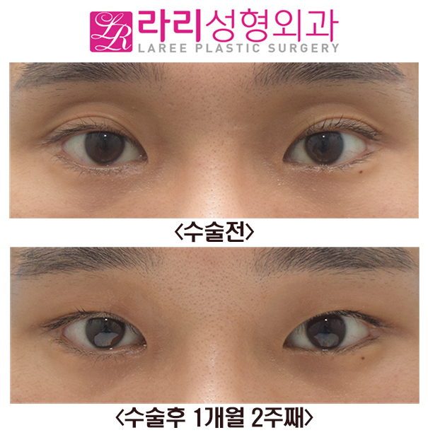 [Lari Plastic Surgery] Sunken Upper Eyelid Fat Grafting + Double Eyelid Removal Before and After Surgery image 1