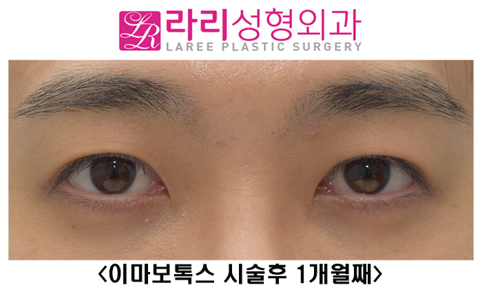 [Lari Plastic Surgery] Should You Get Forehead Botox Before Eye Surgery? image 2