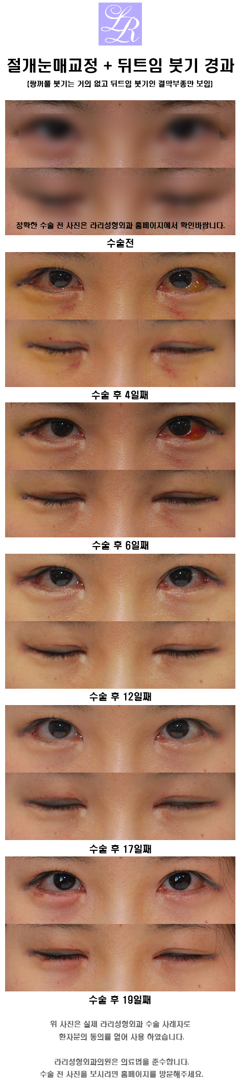 뒤트임 눈매교정 함께 관련 이미지 7