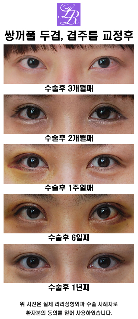 Double Eyelids, Especially When One Eye Has a Double Eyelid image 3
