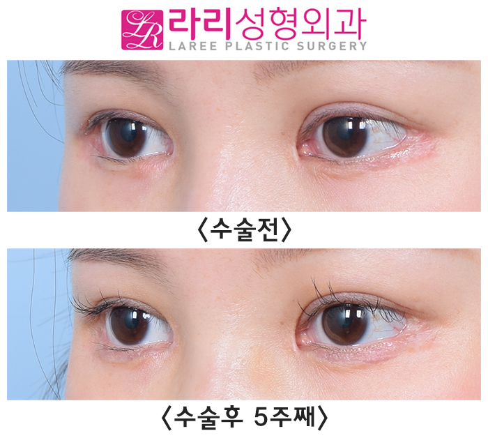 [라리성형외과] 한쪽 쌍수 재수술로 짝눈을 맞춰요. (절개쌍수라인낮추기) 관련 이미지 1