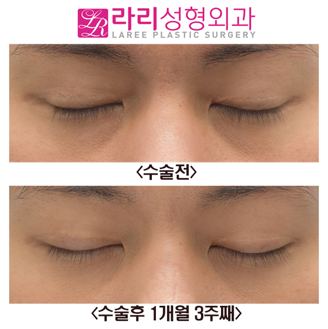[Rari Plastic Surgery] Before and After Right Non-incisional Double Eyelid Reoperation image 4