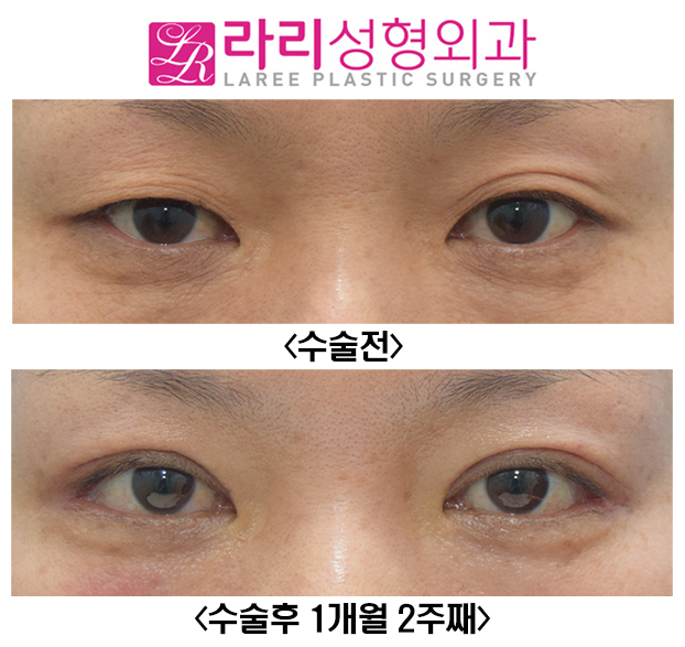 [라리성형외과] 자연스러운 절개눈매교정과 함께한 눈꼬리내리기뒤트임 수술전후 관련 이미지 1