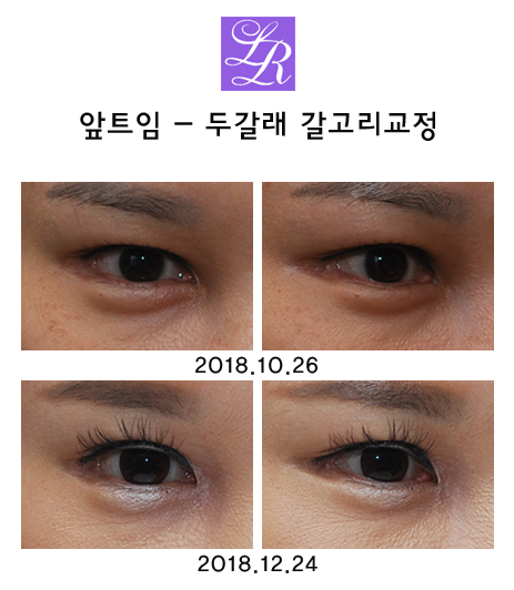 앞트임전후 - 몽고주름 두줄 갈고리 해결 (feat. 라리 트임없는앞트임) 관련 이미지 8