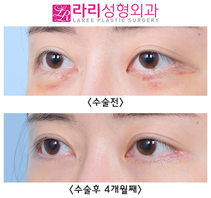 [Lari Plastic Surgery] Revision Double Eyelid Surgery: Micro Line Reduction, Micro Outer Corner Adjustment - Natural as if Nothing Was Done image 4