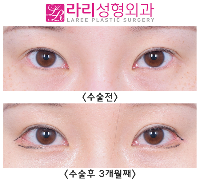 [라리성형외과] 눈꼬리내리기뒤트임효과 확실히 보는 눈 관련 이미지 1