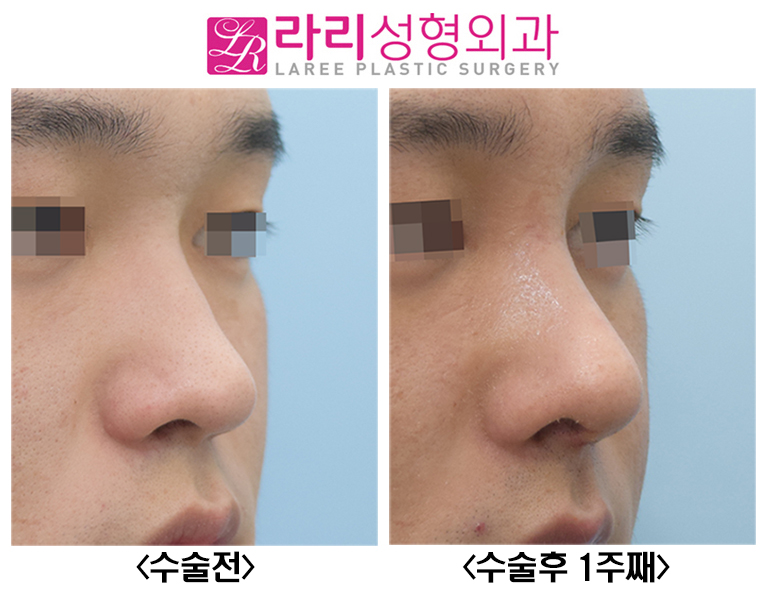 [Lari Plastic Surgery] Before-and-After Photos of Male Rhinoplasty with Rib Cartilage image 2