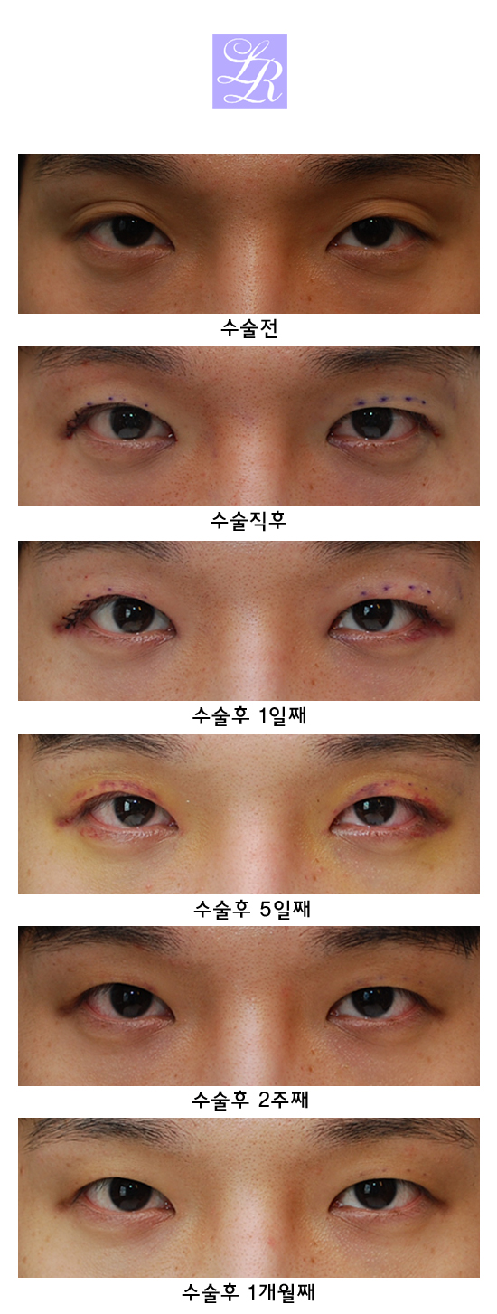 자연으로 생긴 여러겹 쌍꺼풀 없애는 수술 (수술한적 없는 눈) 관련 이미지 1