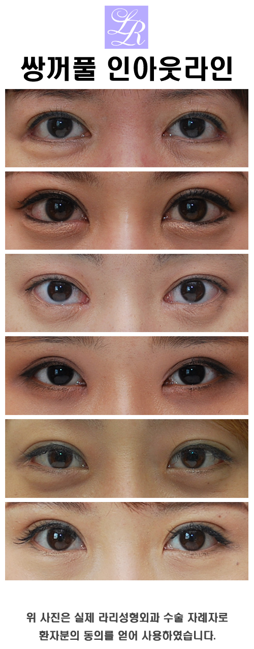 아웃라인 쌍수 높이에 대해 관련 이미지 4