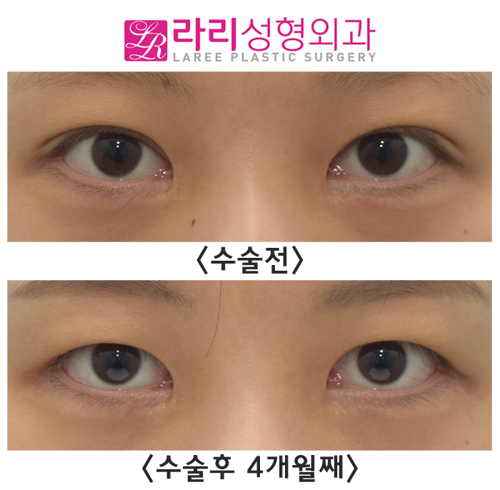 [라리성형외과] 쌍꺼풀없애는수술이 필요한 기준이 있을까? 관련 이미지 1