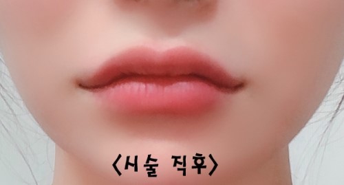 How to Make the Corners of the Mouth Lift Beautifully with Lip Corner Filler image 15