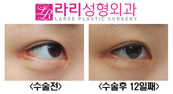 [라리성형외과] 다양한 뒤트임복원수술 전후사진 관련 이미지 2