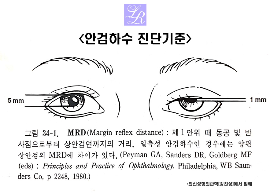 안검하수 수술 후에 쌍꺼풀이 꼭 생기나요? 관련 이미지 3