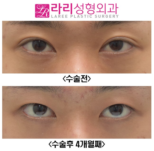 [라리성형외과] 쌍꺼풀없애기 그리고 눈두덩이 꺼짐 교정 (루프지방이식) 관련 이미지 2