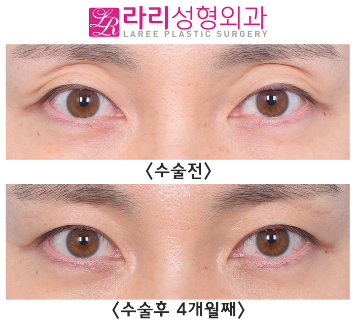 [Lari Plastic Surgery] For Improving Sunken Eyelids: Incisional Double Eyelid Surgery + Upper Eyelid Fat Grafting image 1