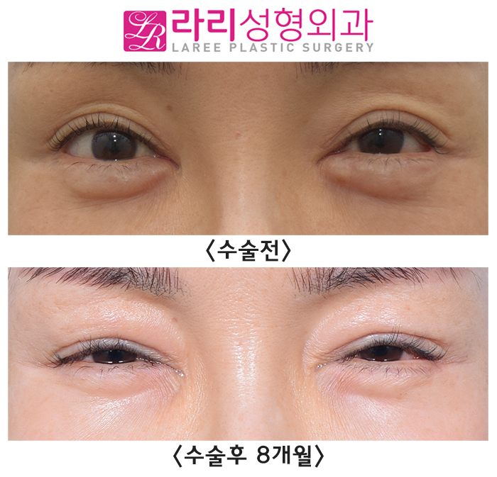 [Laree Plastic Surgery] Aegyo Filler? Permanent Filler? No More Foreign Materials image 2