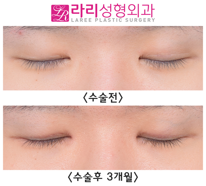 [Rari Plastic Surgery] Pre- and Post-Operation Photos of Uneven Double-Eyelid Correction and Double-Eyelid Removal on Different Sides image 7