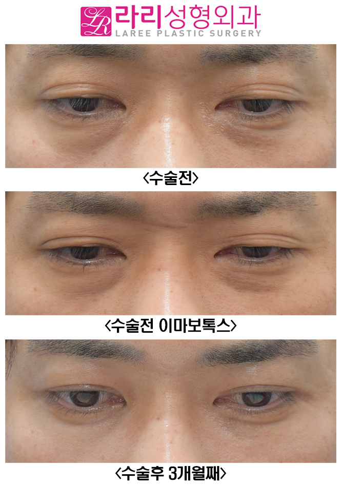 [라리성형외과] 여러겹 쌍꺼풀 제거 관련 이미지 6