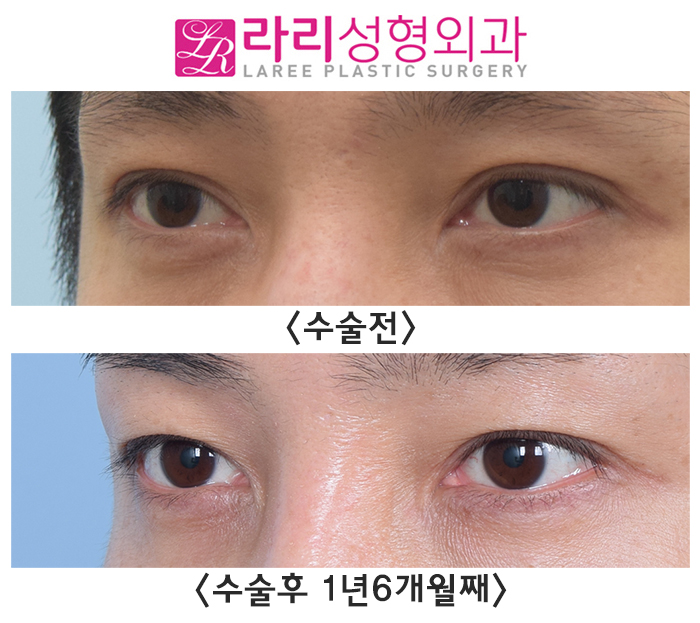 [라리성형외과] 쌍꺼풀없애기 ? 쌍꺼풀라인낮추기 ? 고민이 된다면 관련 이미지 2