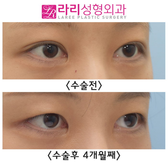 [라리성형외과] 쌍꺼풀없애는수술이 필요한 기준이 있을까? 관련 이미지 2