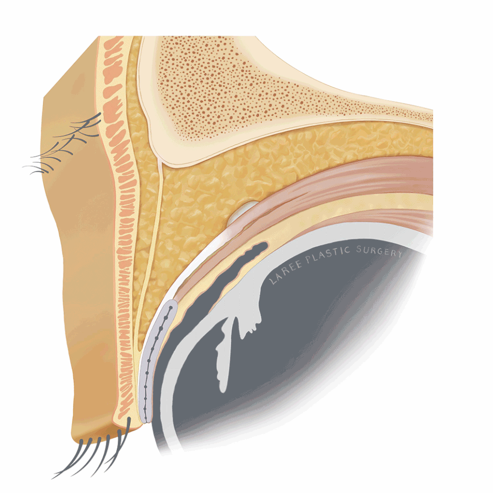 [Lari Plastic Surgery] Eyelid Fat Grafting for Improving the Eyelid Hollow: Incision Method vs. Non-Incision Method image 5